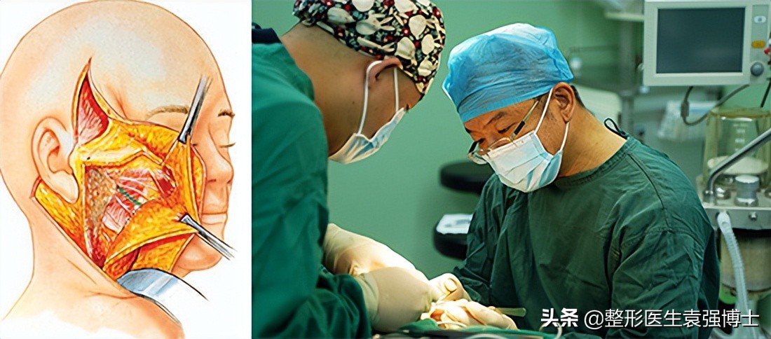 拉皮后10年后的后遗症的真实案例,拉皮手术后遗症出现在什么时期