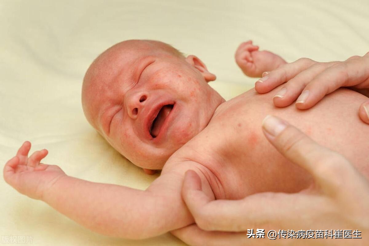 换了氨基酸奶粉宝宝还是反复湿疹,眼睛周围湿疹容易反复怎么能根除