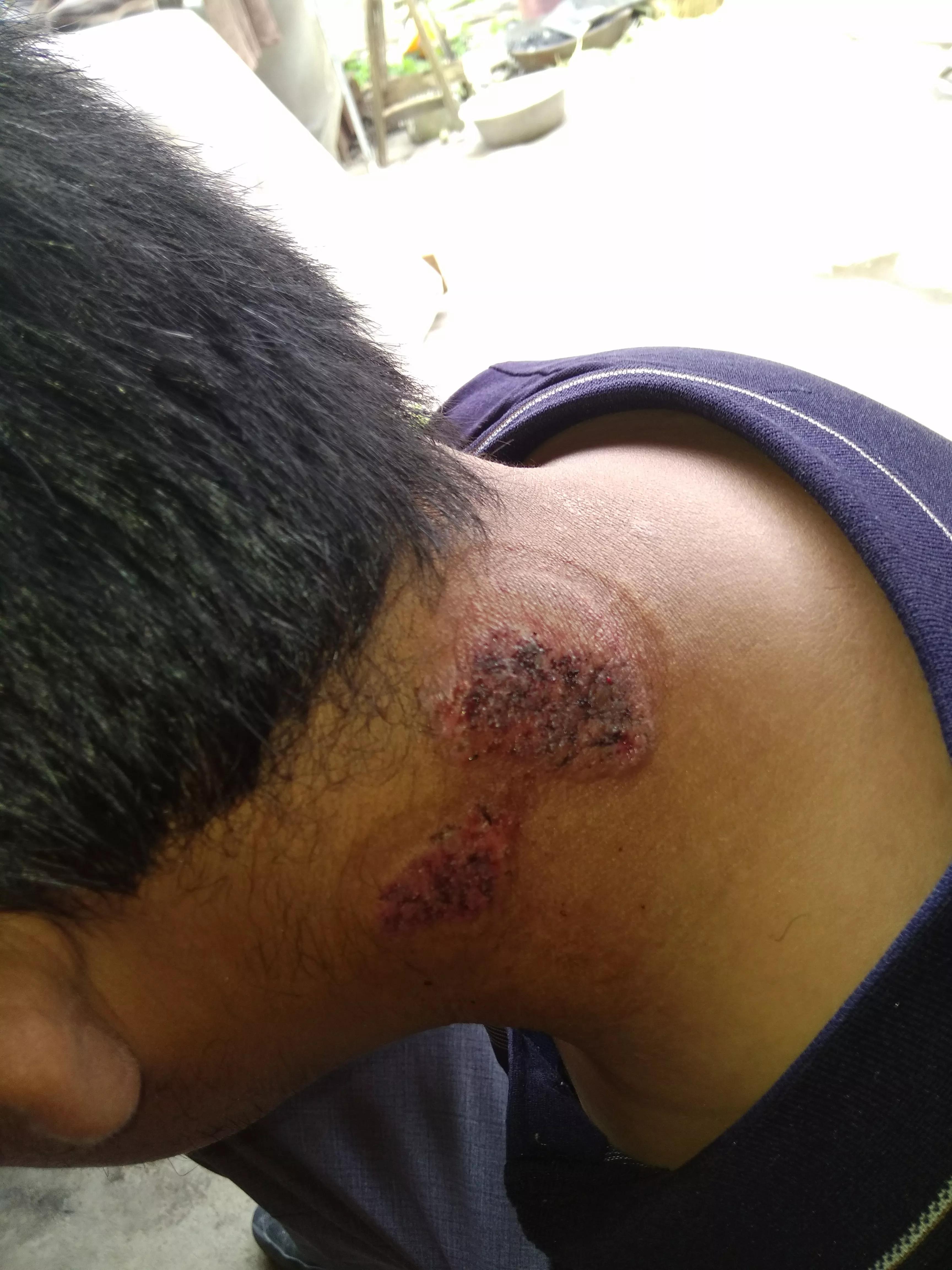 牛皮癣伴随一生是怎么样的体验,对抗牛皮癣一直在坚持