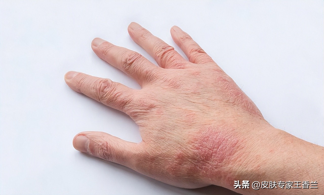 湿疹治标不治本怎么办,湿疹治不好怎么办