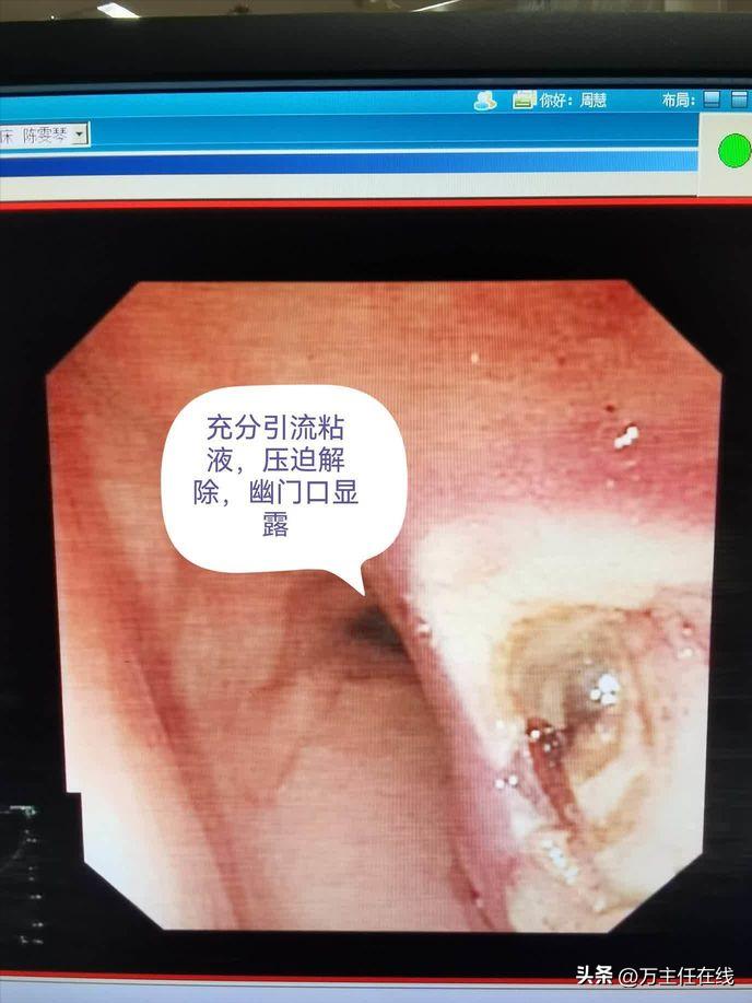 腹腔粘液癌治疗有妙招——万荣教授以内镜Notes技术成功胃减压