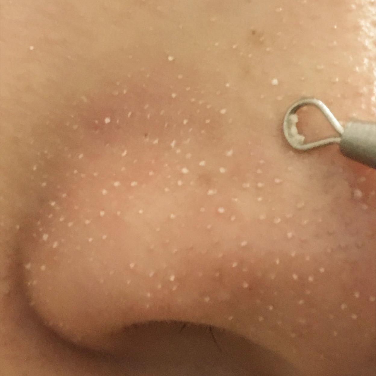 去除鼻子黑头收缩毛孔小妙招,鼻子黑头毛孔大抹什么药膏