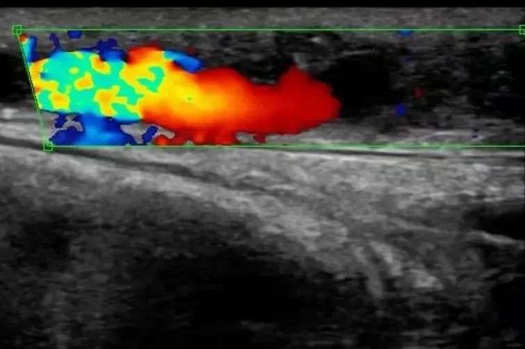血管造瘘透析,血管人工搭桥