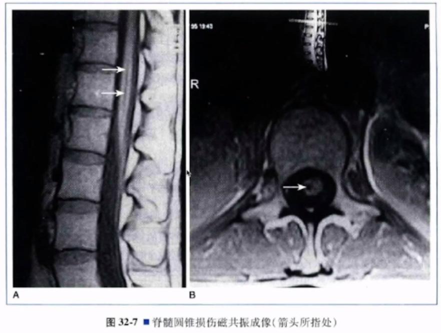 李歆跃：围产期神经系统并发症