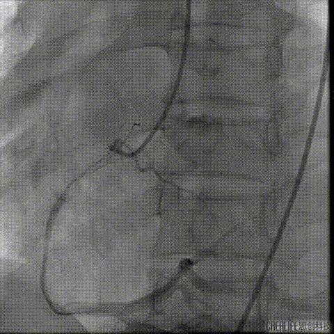 病例回顾与分享,腹膜后血肿介入治疗