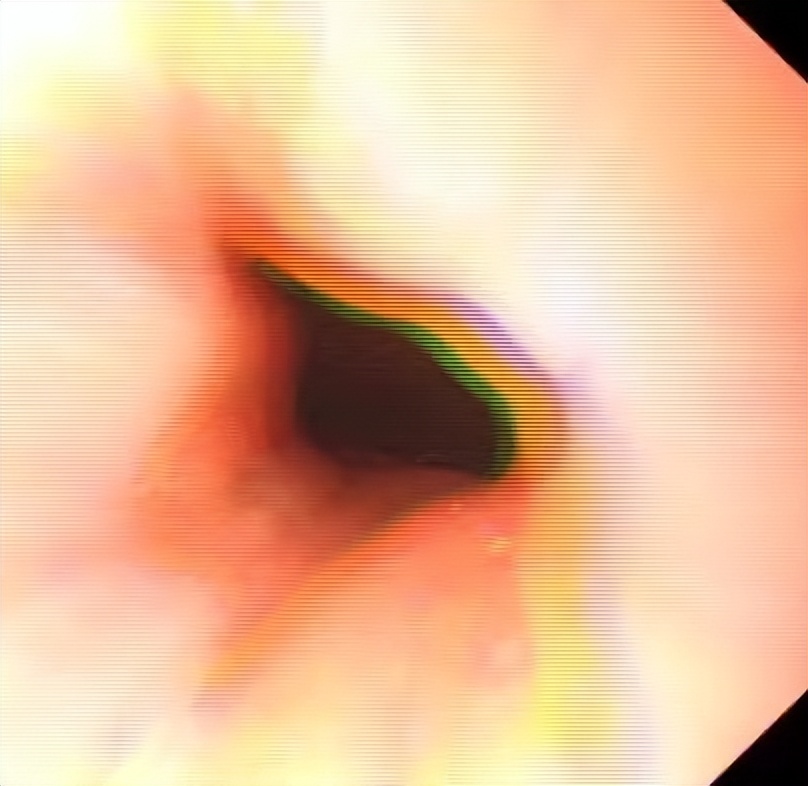 胃片怎么拍,胃造影的流程