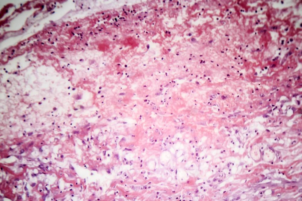 朊病毒大爆发可能性,朊病毒是不是致死率最高的病毒