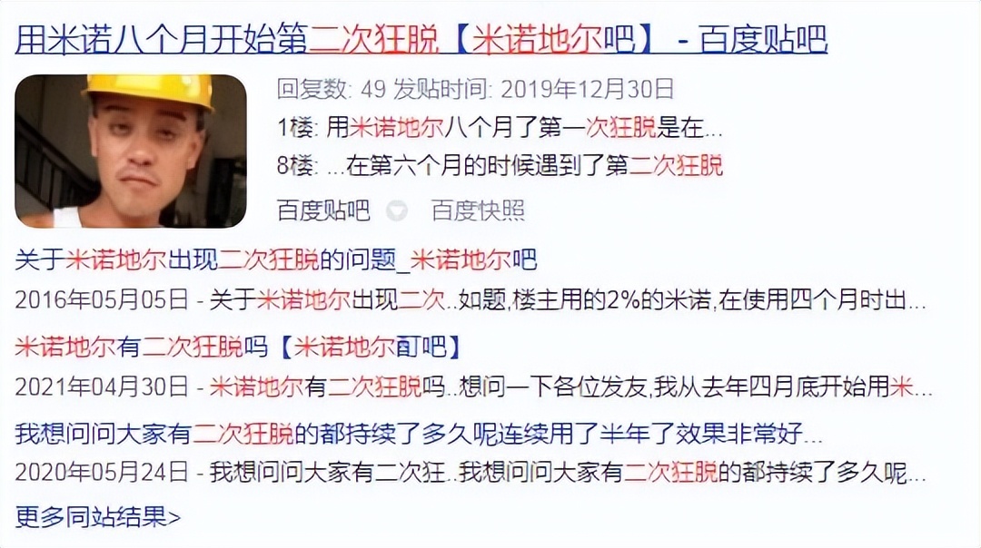 用米诺地尔两个星期疯狂掉头发 (使用米诺地尔期间掉头发更多了)