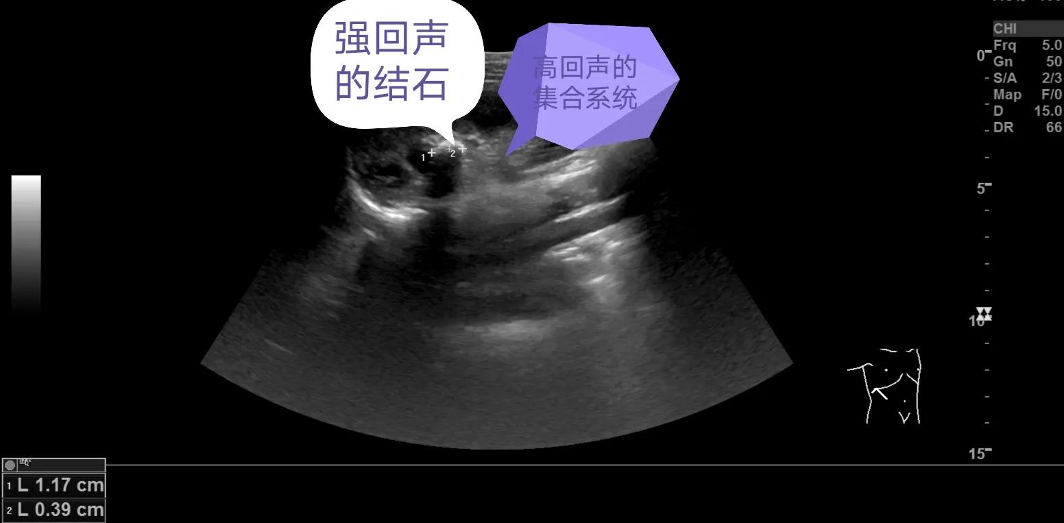 解读肾脏超声检查报告:肾结石、肾结晶、肾钙化灶到底什么关系?
