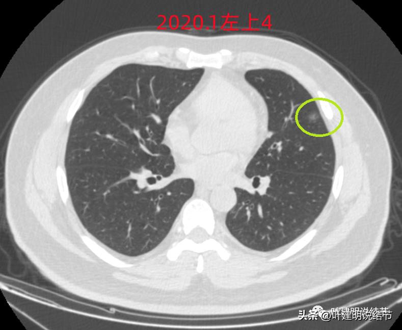 如何判断肺磨玻璃结节是高危结节,肺上有混合磨玻璃结节要注意什么