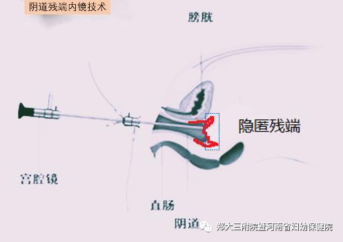高危hpv1652自己转阴的概率是多少,hpv高危82型感染了三年了还未转阴