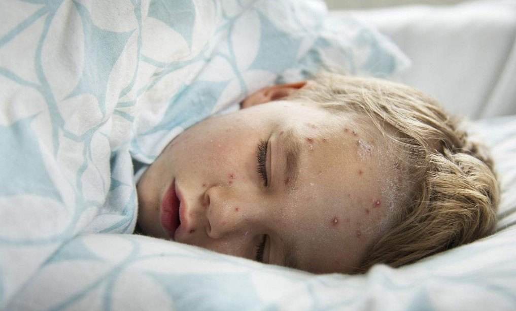 带状疱疹疫苗1401多少钱一支,带状疱疹疫苗有必要打几针