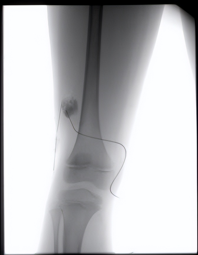 介入治疗淋巴管畸形的医学进展,淋巴管瘤有没有可能误诊