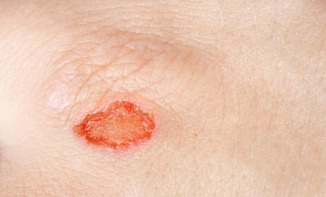 结痂的伤口，痒到怀疑人生，到底该怎么对待？看看医生怎么说