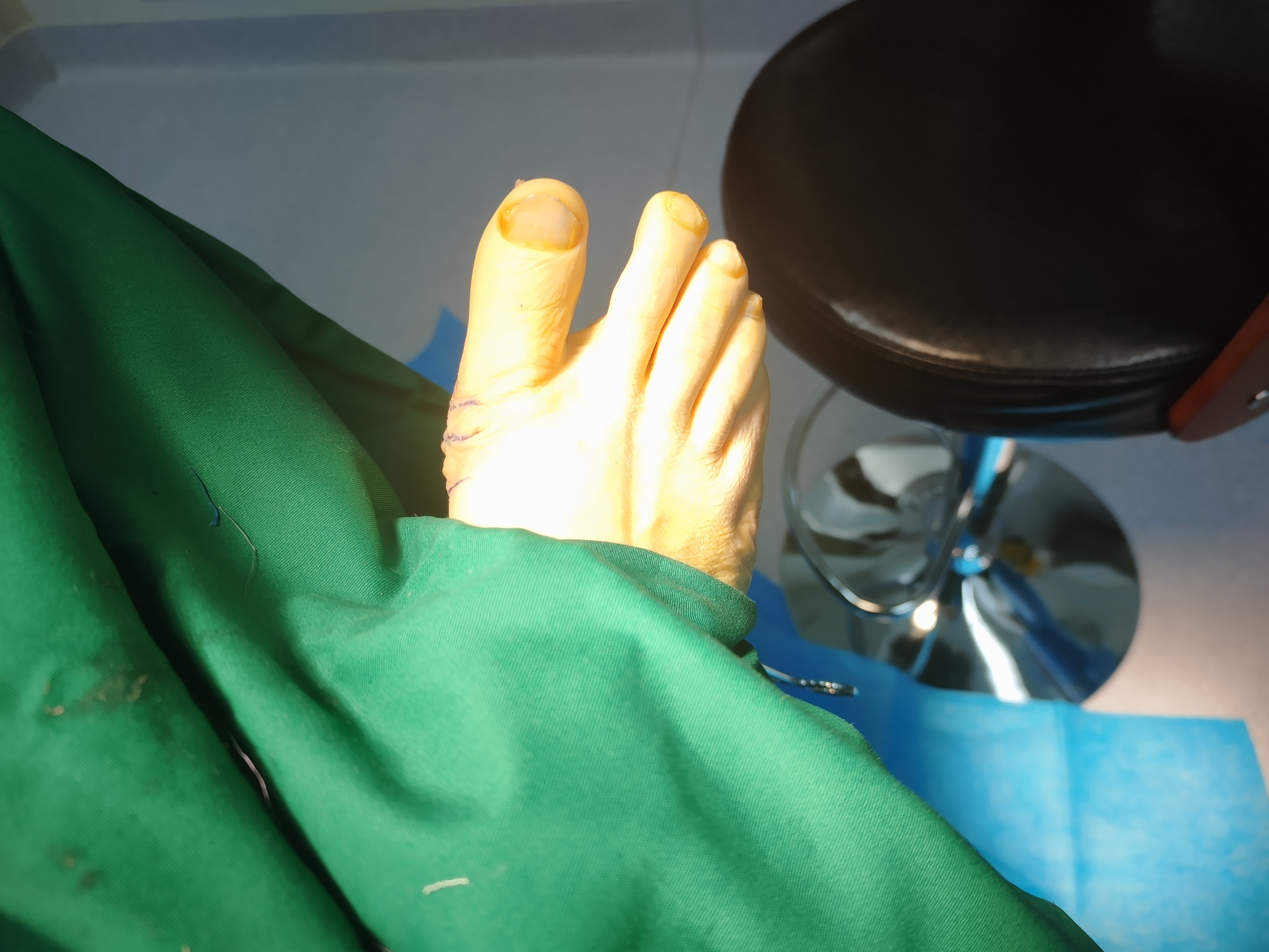 脚宽是否可以做窄？脚宽怎么办，没有拇外翻脚宽