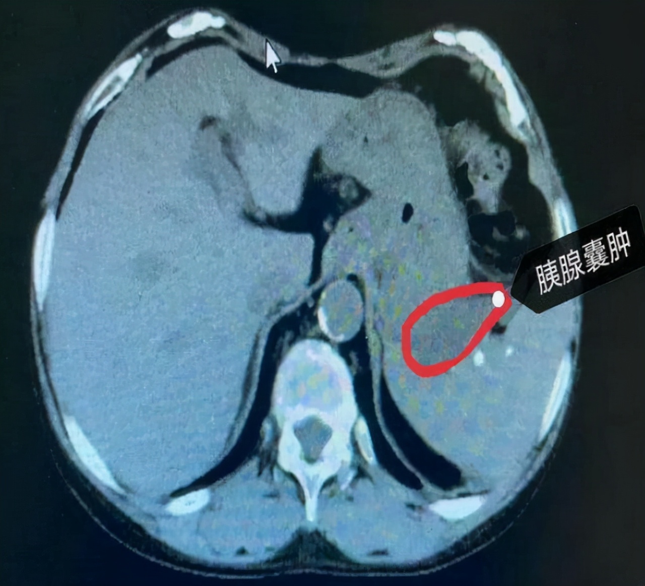 医生说有个囊肿是怎么回事,医生处理囊肿