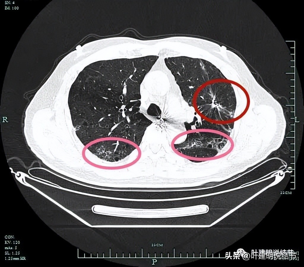 pet判断淋巴结转移,petct判断癌有没有转移准确吗