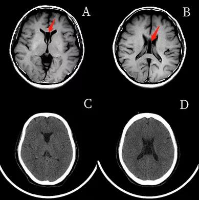 侧脑室就是透明隔腔吗,第五脑室是透明隔吗