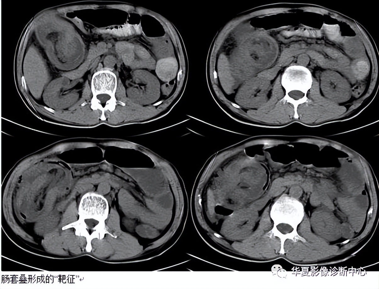 腹部影像基本特征与诊断,腹部反射区与病症对照图