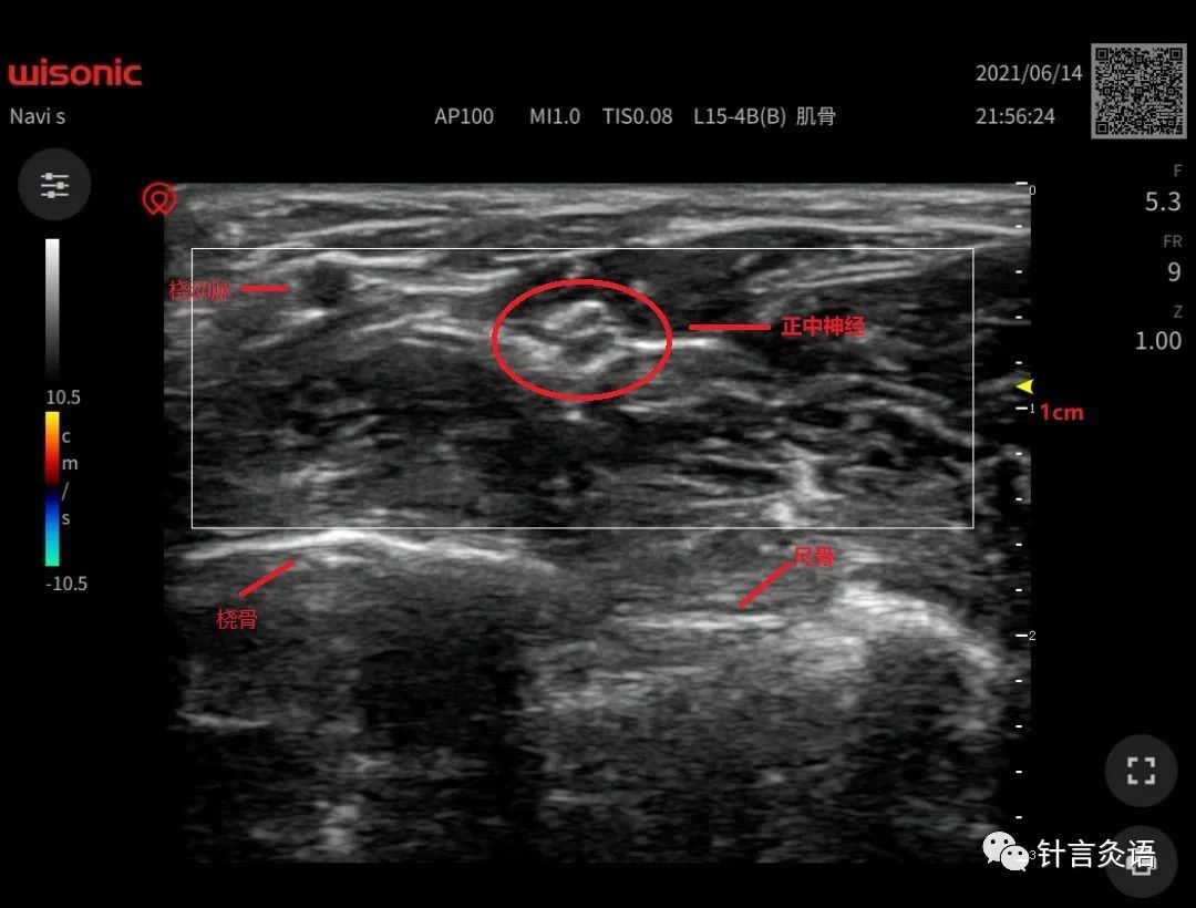 针灸基本功系列第3篇,针灸基础知识五腧穴的背诵方法