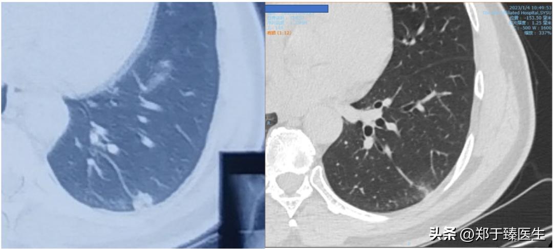 新冠病毒是如何损坏肺功能的,新冠病毒引起的肺部炎症怎么办