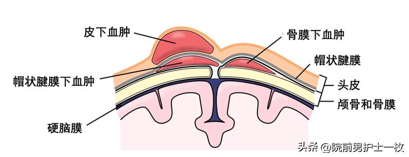 重型颅脑外伤患者急救护理措施,颅脑外伤病人的应急处理