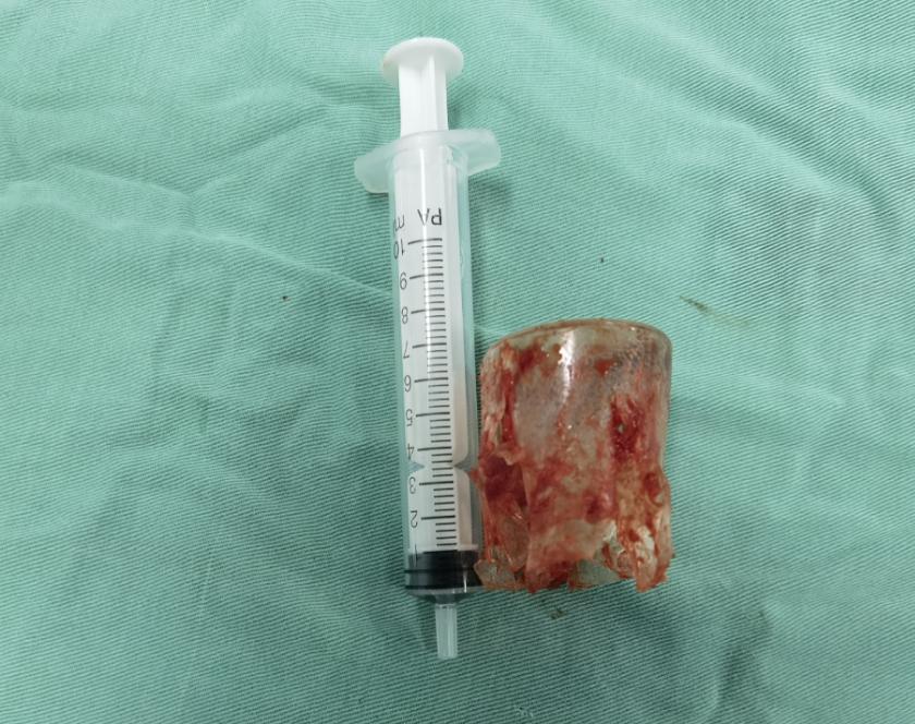 家长警惕！少女*体下**流脓、发臭半年，医生竟从私密处取出塑料瓶盖