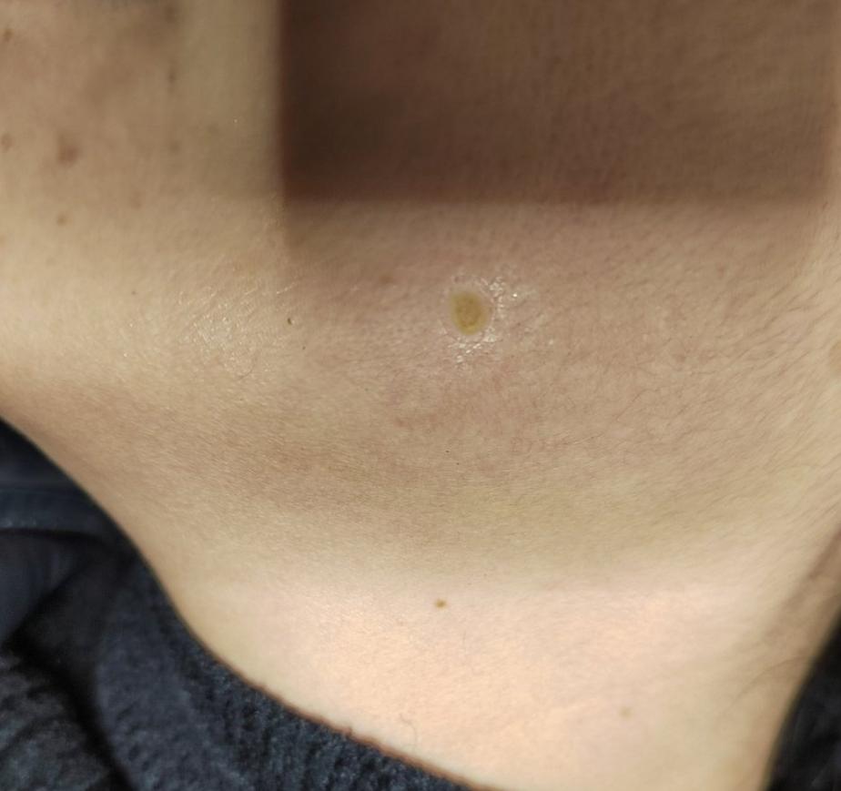 脸上长黑色素痣怎么回事,脸上黑色素痣凸起会痒