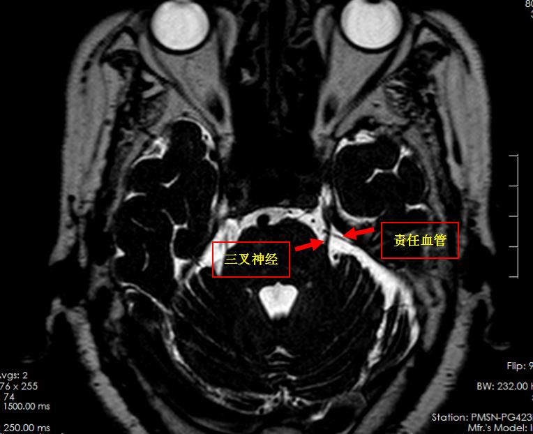 天下第一痛如何止痛,天下第一痛怎么缓解