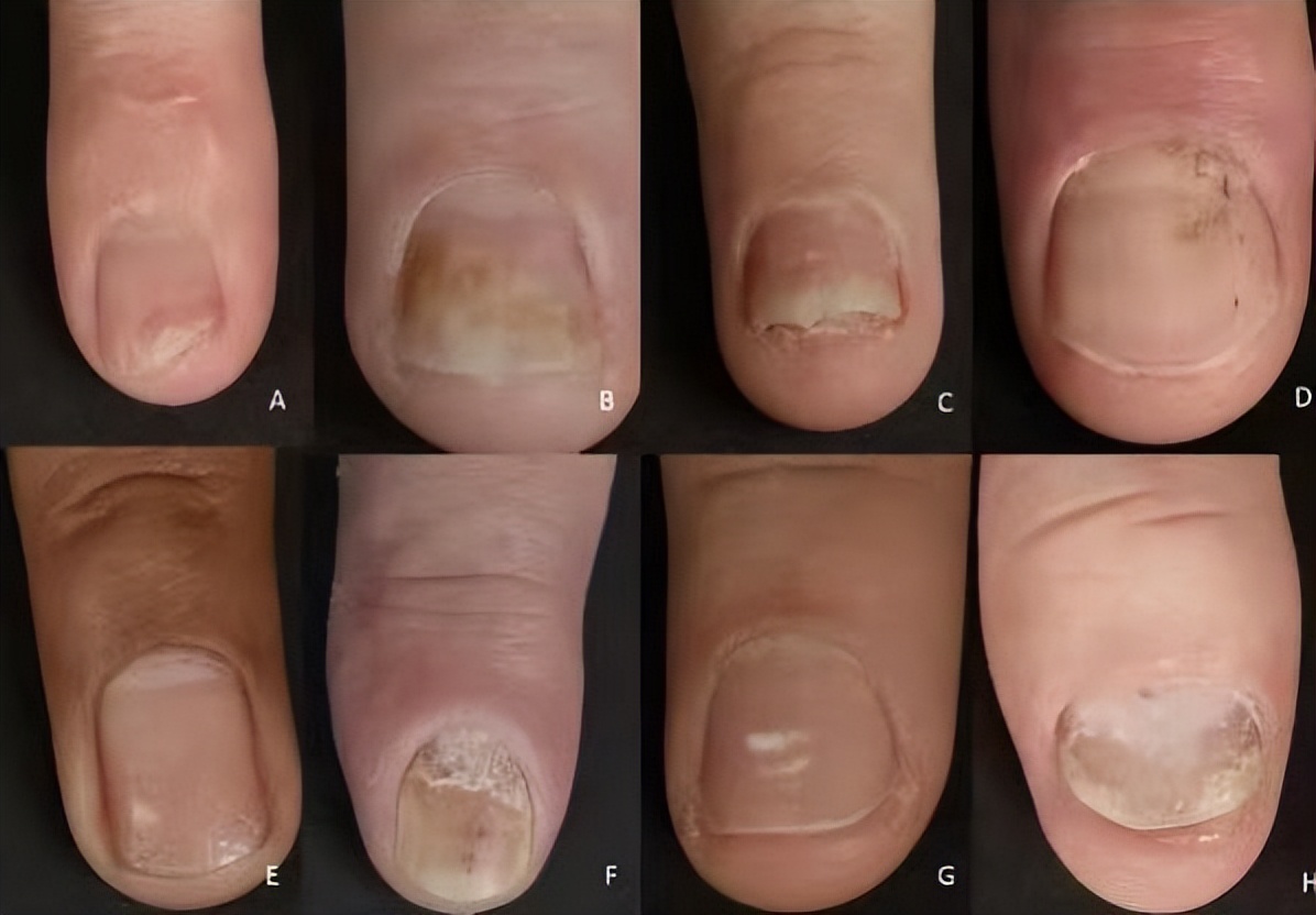 风湿免疫类疾病最怕什么,风湿免疫疾病如何预防