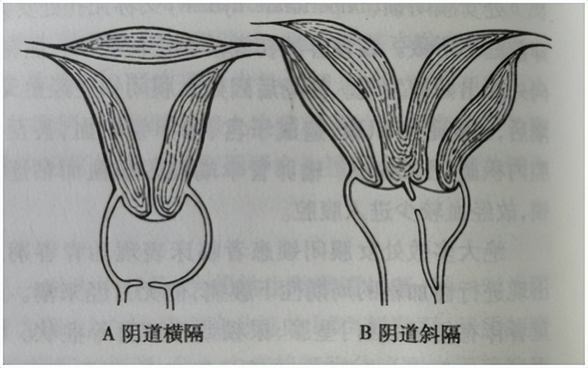 女子检查身体发现自己有两个子宫,女子查出有两个子宫