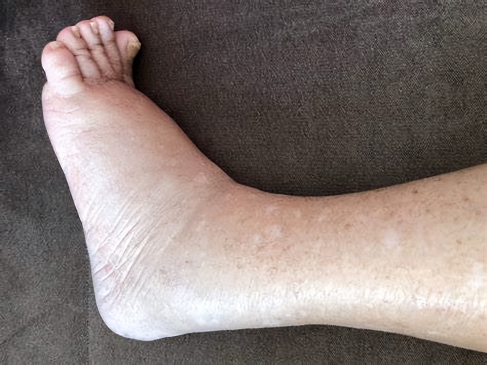 足踝术后怎么消肿,足跟骨术后肿胀如何消除