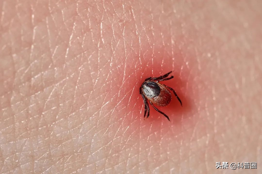 致命蜱虫,比蜱虫还可怕