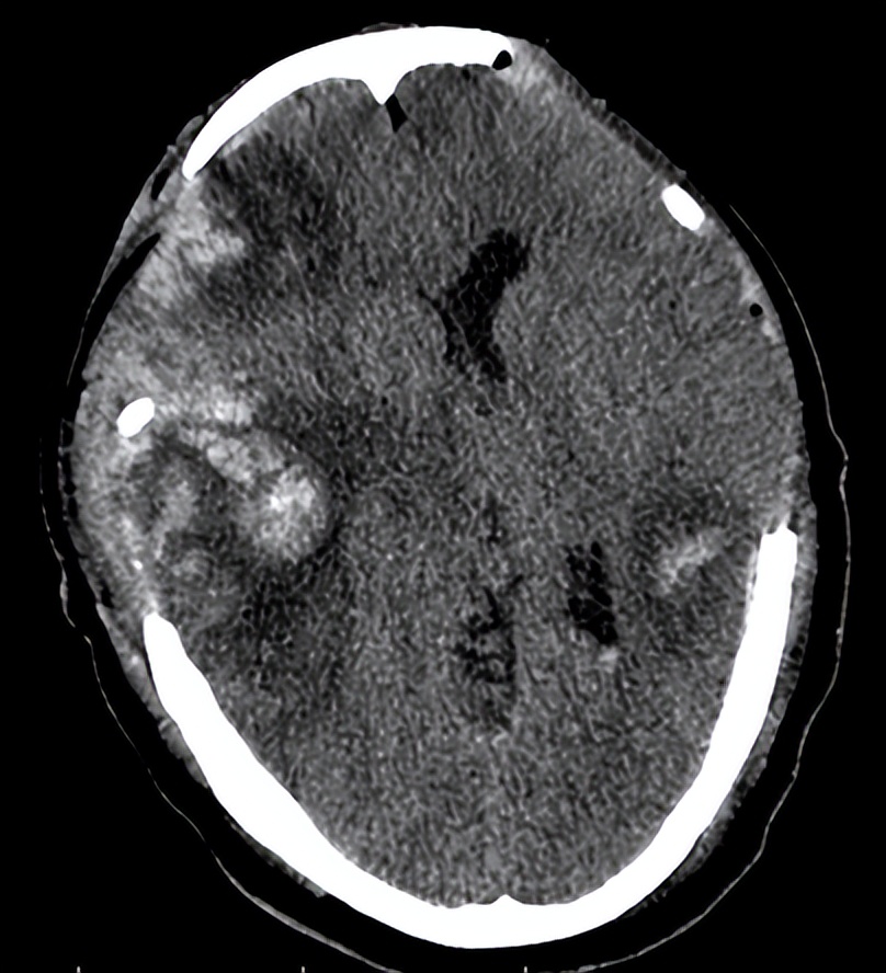 医院成功救治重型颅脑患者,特重型颅脑损伤治愈案