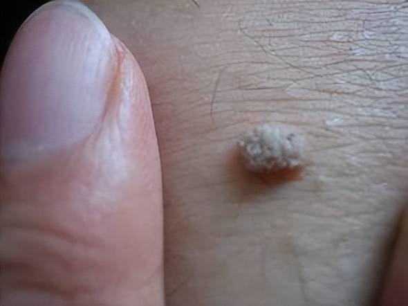 脖子和腋下的“小肉粒”是什么？能用手抠掉吗？看看医生如何说