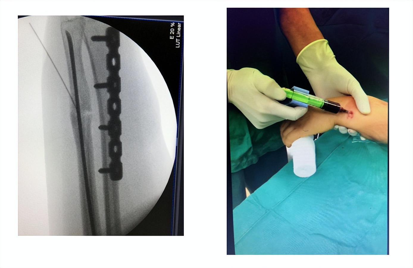 治疗骨折新技术,微创手术治疗骨折的方法