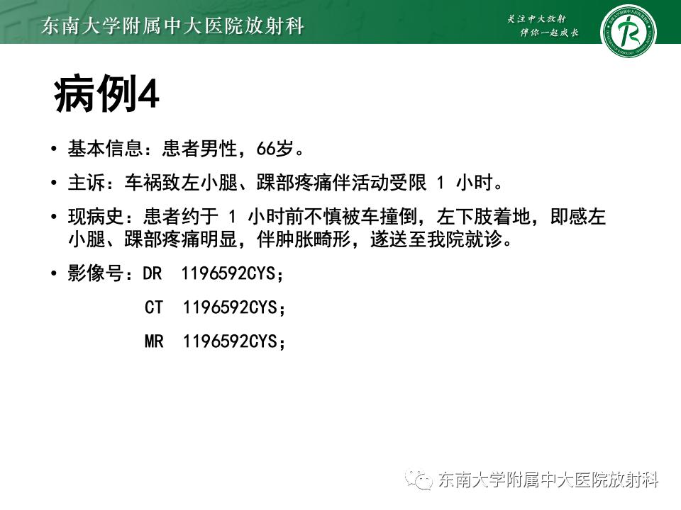 左腓骨下段骨折伴下胫腓联合分离,好文分享深度揭秘