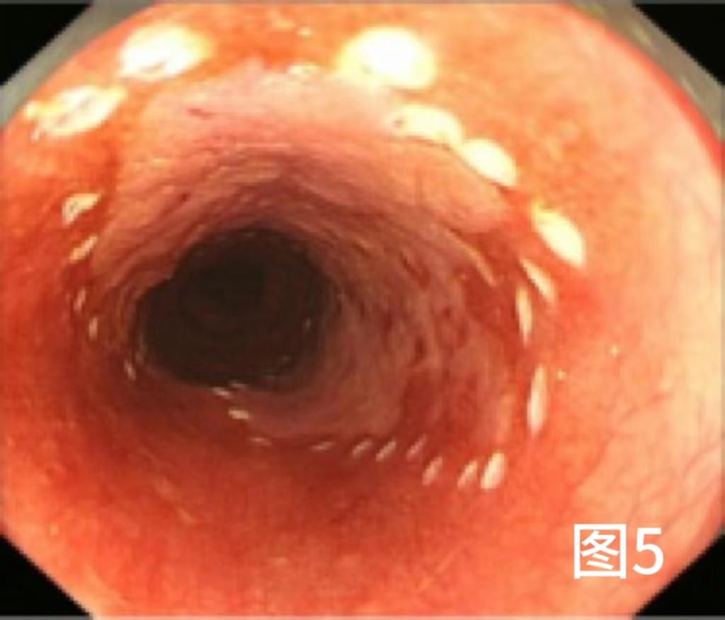 病例档案纪录片,食管早期癌的内镜筛查