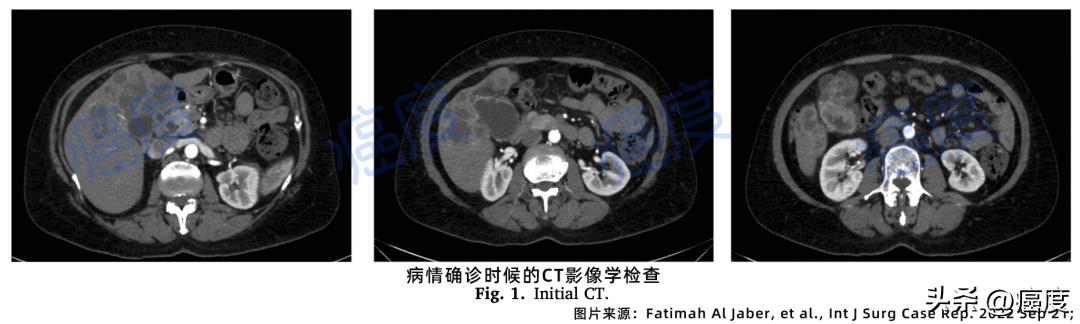 有效就是王道，晚期胆囊癌通过手术获得长期生存
