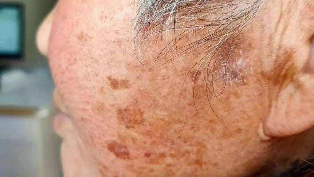 为什么人老会有老年斑怎么消除,为什么会有老年斑怎么去掉