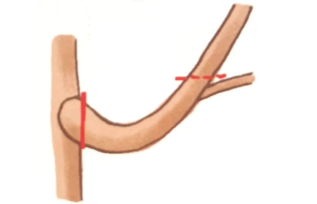 榆树盆景鸡爪枝修剪,映山红盆景花后怎样修剪枝