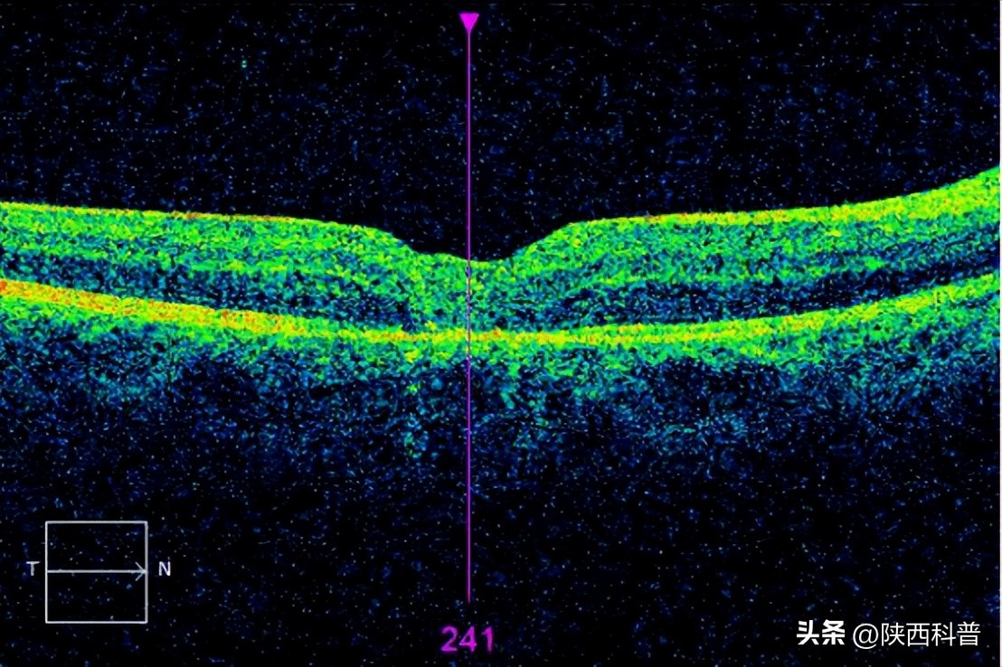 用眼过度导致眼睛凹陷,用眼过度肿起来了