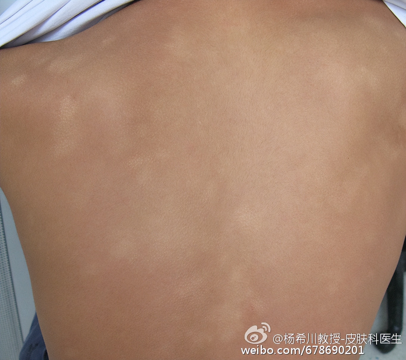 有什么白斑是不用治疗的,白斑怎样治疗才能消失呢