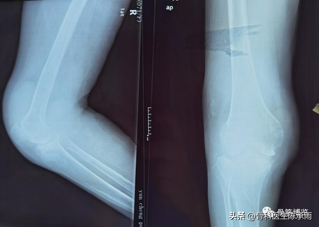 化脓性关节炎的穿刺引流治疗,关节炎镜下治疗