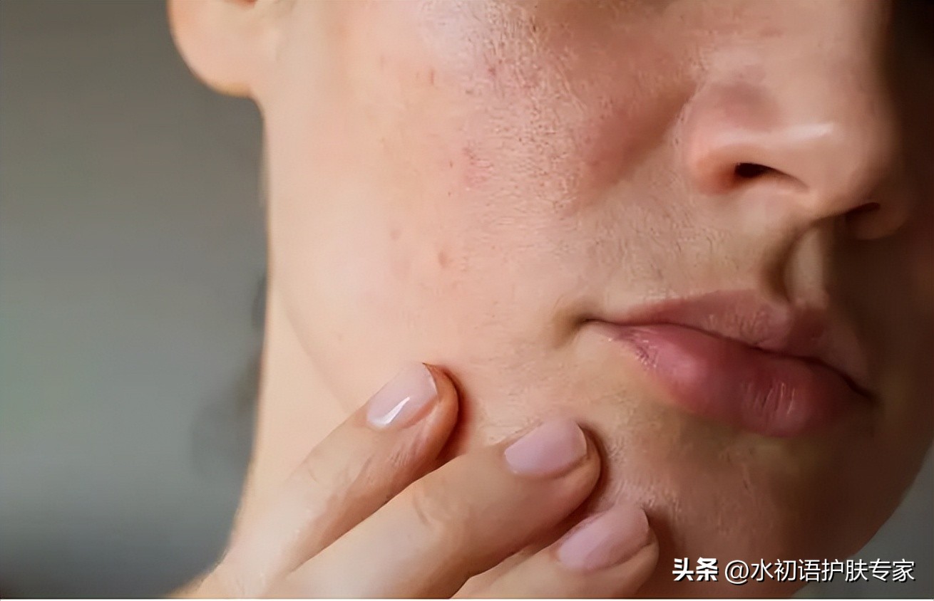 暗沉起皮毛孔大用什么护肤,皮肤油毛孔粗大暗黄用什么护肤品