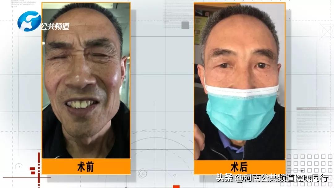 射频消融手术治疗梅杰综合征,梅杰综合征微创手术治疗