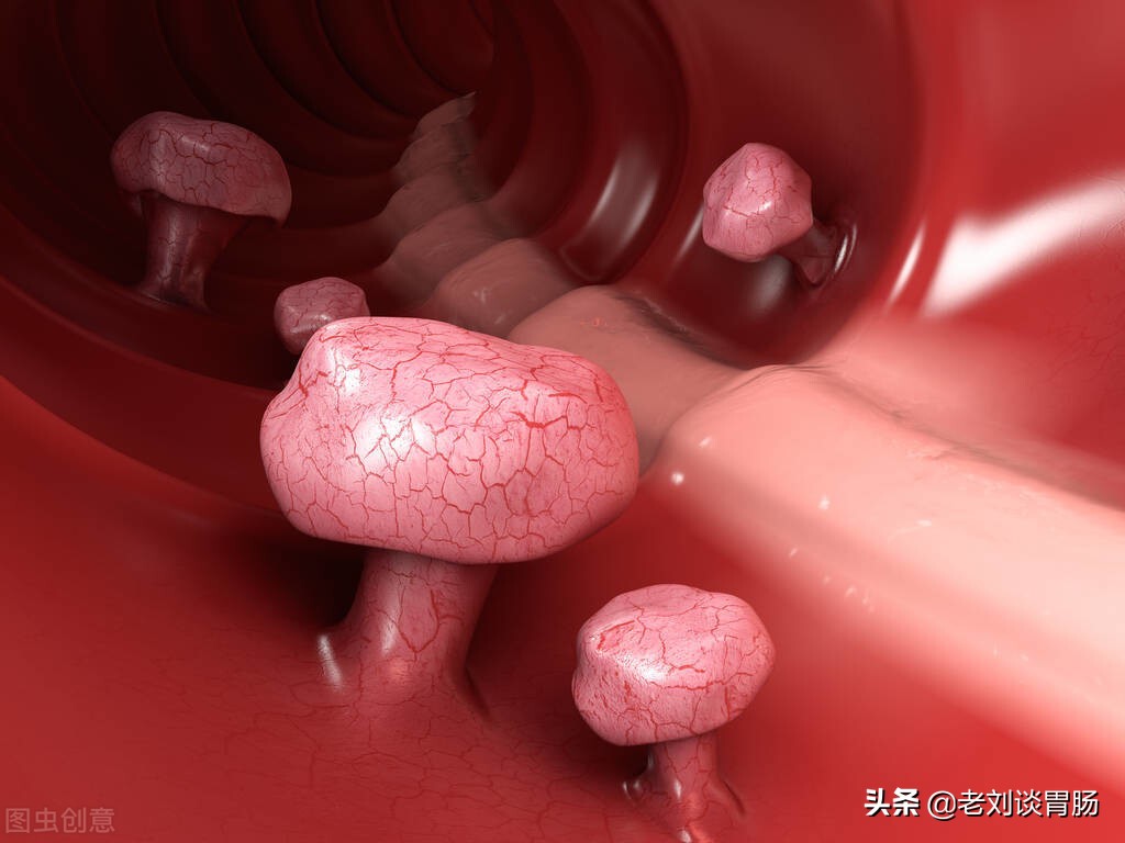 肠镜检查出直肠息肉怎么办,做肠镜发现肠息肉怎么办