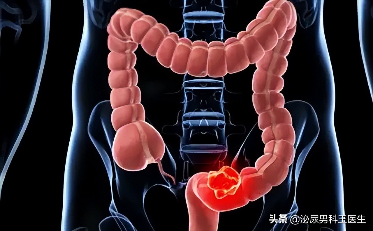 直肠癌早期身体发出3个救命信号,直肠癌症状是先下坠还是便血
