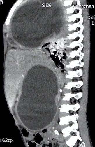 小男孩患虫癌,7岁男孩患虫癌