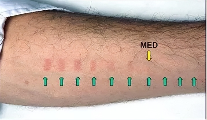 白癜风照光后起水泡破皮怎么办,白癜风手上晒出水泡怎么办